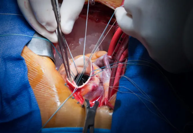 Mitral Valve Replacement Hospital in PCMC,Pune image 1